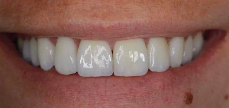 Nakon zahvata ljuskica i smile makeovera